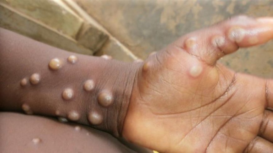 Abia State Records First Case of Monkeypox, Health Authorities Mobilize Respose